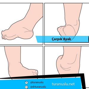 Çarpık ayak , çarpık ayak tedavisi , çarpık ayak nedir , çarpık ayak neden olur , ayak ağrıları