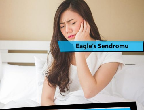 Eagle’s Sendromu (Uzun Stiloid Proses Sendromu)
