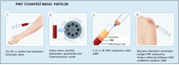 Prp Tedavisi Prp Tedavisi Nedir Prof Dr Turan Uslu 0092